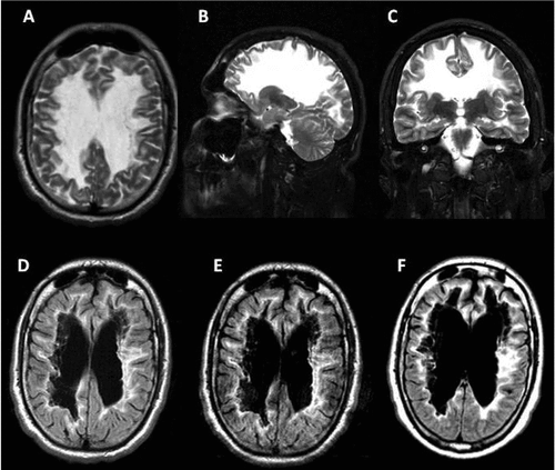 Vanishing White-Matter Disease: A Case of Severe Adult Onset With ...