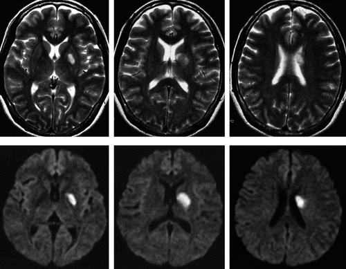 Patient With Globus Pallidus Infarction Presenting With Reversible ...
