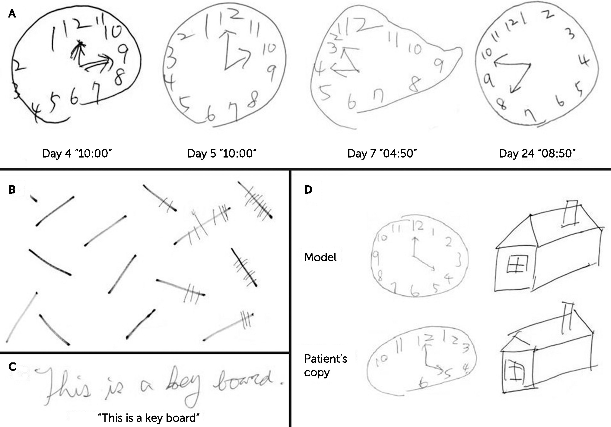Reversible Mirror Clock Drawing After Acute Right Frontoparietal Lobe