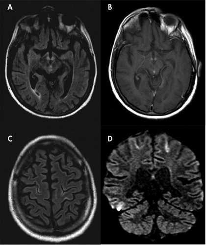 Cortical Linear Lesions in Wernicke’s Encephalopathy: Can Diffusion ...